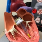 Aortic Valve Disease