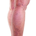 Banishing Spider Veins: Understanding Sclerotherapy and the Importance of Expert Evaluation!