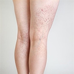 Beyond the Surface: Understanding Varicose Veins and Venous Insufficiency – Expert Care with Dr. Tamim!