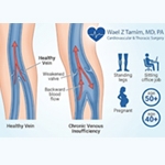 The Hidden Triggers-What Actually Causes Spider Veins?