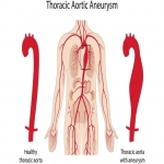 Thoracic Aortic Aneurysm, Facts and Endovascular Treatments!