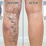 Varicose Veins vs. Spider Veins: A Guide to Leg Health and When to Seek Care