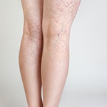 Your Search for Excellent and Affordable Vein Treatment in South Florida Ends Here