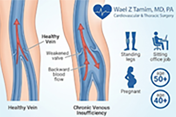 The Hidden Triggers-What Actually Causes Spider Veins?